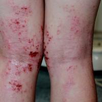 
	Atopic eczema