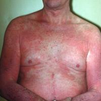 
	Atopic eczema in an adult