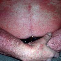 
	Atopic eczema - same patient as previous…