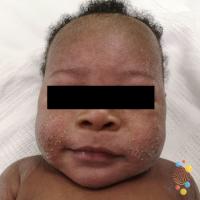 Atopic eczema&nbsp;
Copied with kind permission…