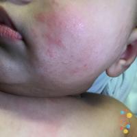 Atopic eczema
Copied with kind permission from…