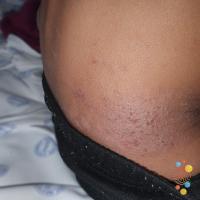 Atopic eczema
Copied with kind permission from…