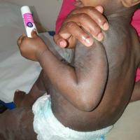 Atopic eczema
Copied with kind permission from…