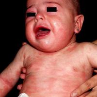 
	Atopic eczema
	
	Atopic eczema can cause…
