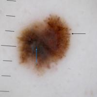 
	Dysplastic naevus with a suspicious dermoscopic…
