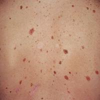 
	Many naevi (atypical and typical) - referral…