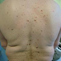 Atypical melanocytic naevi
A large numbers of…