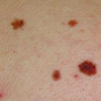 
	Atypical melanocytic naevi - close up 

	Copied…