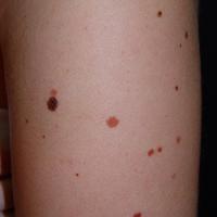 This many lesions on an arm is very likely to…
