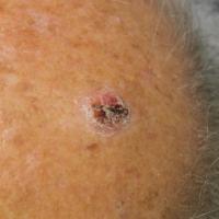 
	Atypical fibroxanthoma

	Surrounding skin shows…