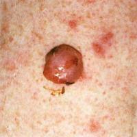 
	Atypical fibroxanthoma