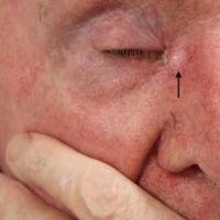 
	BCC - eyelid stuck down
	A BCC recurrence…