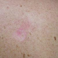 
	Superficial BCC on back - no history…
