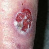 
	Basosquamous carcinoma