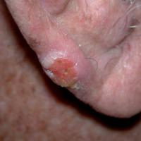 
	Basosquamous carcinoma right ear 