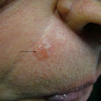 Infiltrative BCC right side of face