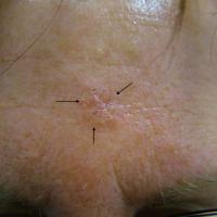 Infiltrative BCC forehead