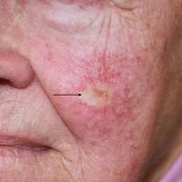 Infiltrative BCC left cheek