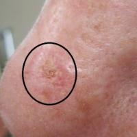 
	BCC and AK&nbsp;nose - crust, scale or…