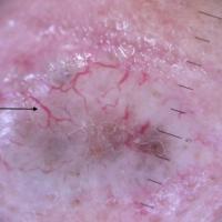 Dermoscopic appearance of previous figureArrow…