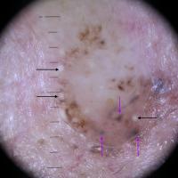 Dermoscopic appearance&nbsp;of previous…