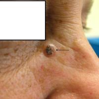 Solid BCC right upper noseIt is not uncommon for…