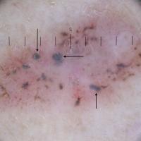 Dermoscopic appearance of previous figureEven…