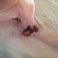 BCC under ear - ulcerated&nbsp;This lesion had a…