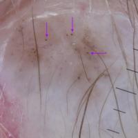 Dermoscopic appearance of previous figureArrows…
