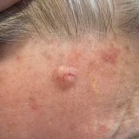 Some BCC don't need a dermatoscope for…