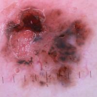 Dermoscopic appearance of previous…