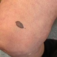 Melanoma - full cutaneous examinations are…
