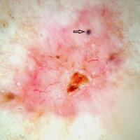 Dermoscopic appearance of previous…