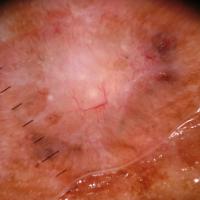 
	Dermoscopic appearance of previous figure