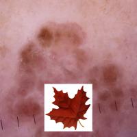 Dermoscopic appearance of previous…