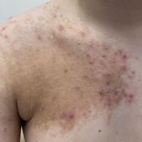 Acne within a Becker's naevus