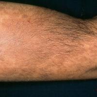 
	Becker's naevus at an atypical…