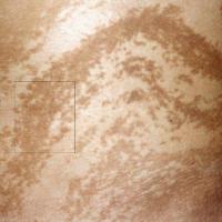 Blaschkoid hyperpigmentation
Referral needed