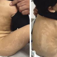 Blaschkoid hypopigmentation - referral needed