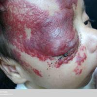 Port-wine stain - present at birth
Same day…
