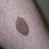 Congenital melanocytic naevus
As with other…