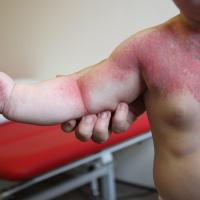 Extensive capillary malformation needing…