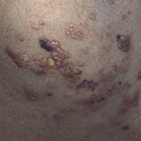 Lymphangioma circumscriptum
A type of lymphatic…