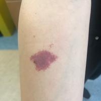Port-wine stain - localised&nbsp;on arm
No…