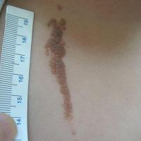 Verrucous epidermal naevus
Biopsy needed to…