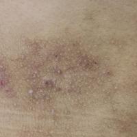 
	Atopic eczema&nbsp;

	In darker skin prominent…