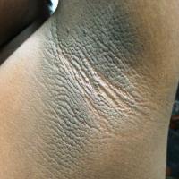 
	Acanthosis nigricans