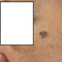 
	Basal cell carcinoma