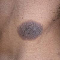 
	Fixed drug eruption

	Always arises at the same…