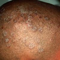 
	Tinea capitis&nbsp;